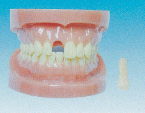 可卸式無根标準牙模型B10028 