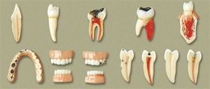 牙齒病變系列模型B10017 