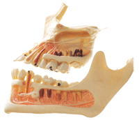 牙體病變模型B10016 