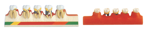 牙周病分類模型B10014