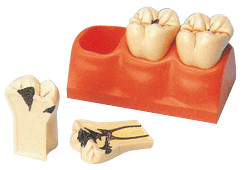 齲齒分解模型B10009